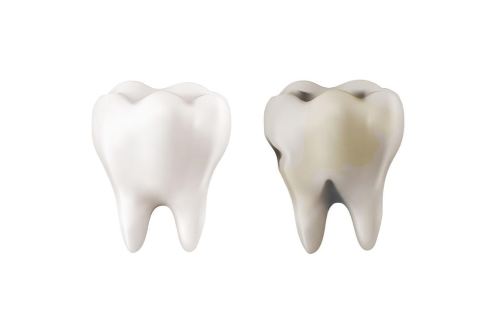 7 Signs You Have a Cavity