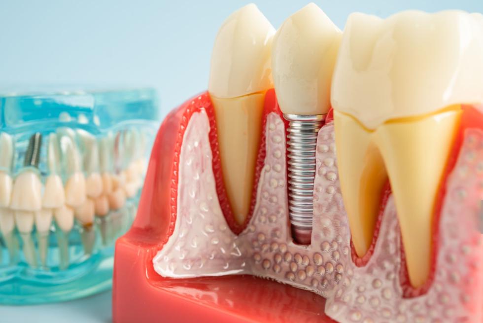 How To Use a Dental Lab Scanner To Scan an Implant Model With Abutment
