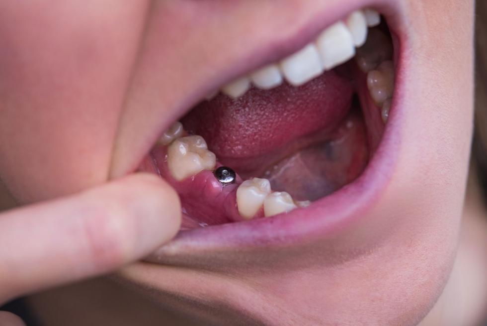 Can a Failed Dental Implant Be Replaced? Your Ultimate Guide to Replacement Dental Implants
