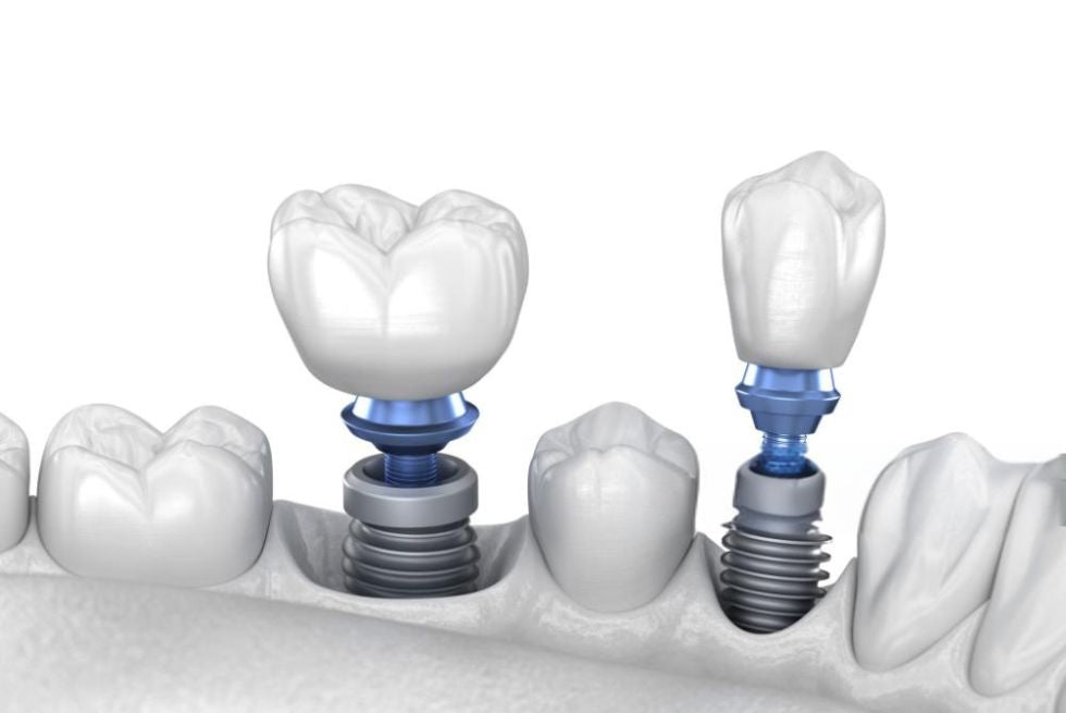 Can You Get Multiple Dental Implants Placed in One Appointment? A First-Hand Guide