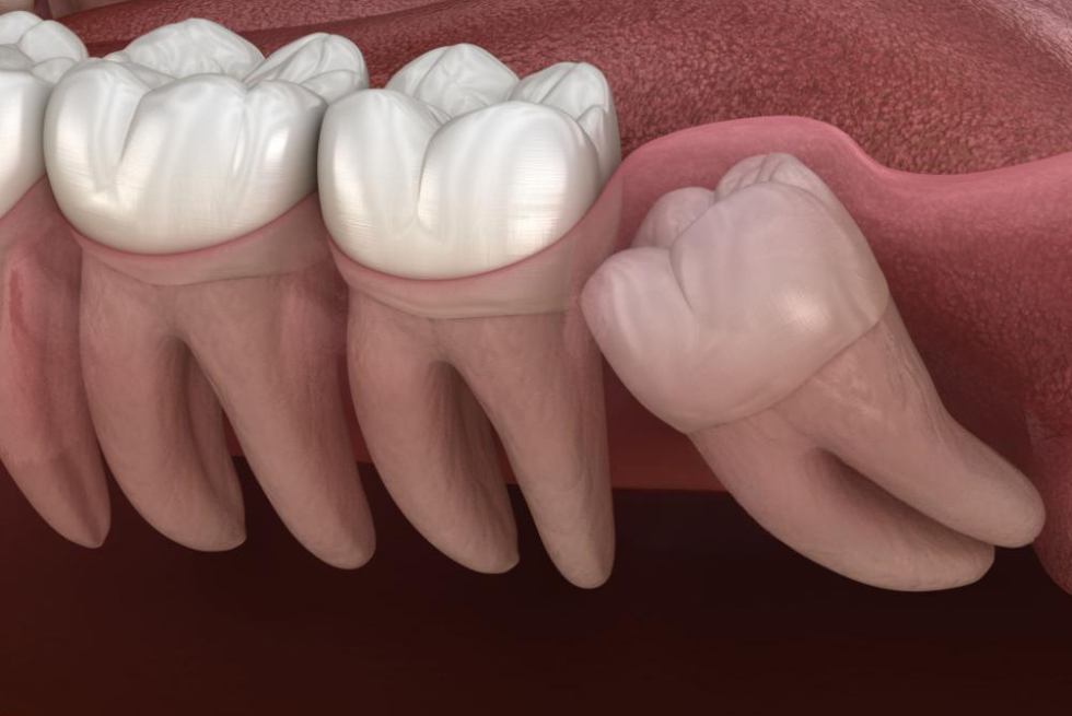 Do You Have Wisdom Teeth? Facts & Statistics