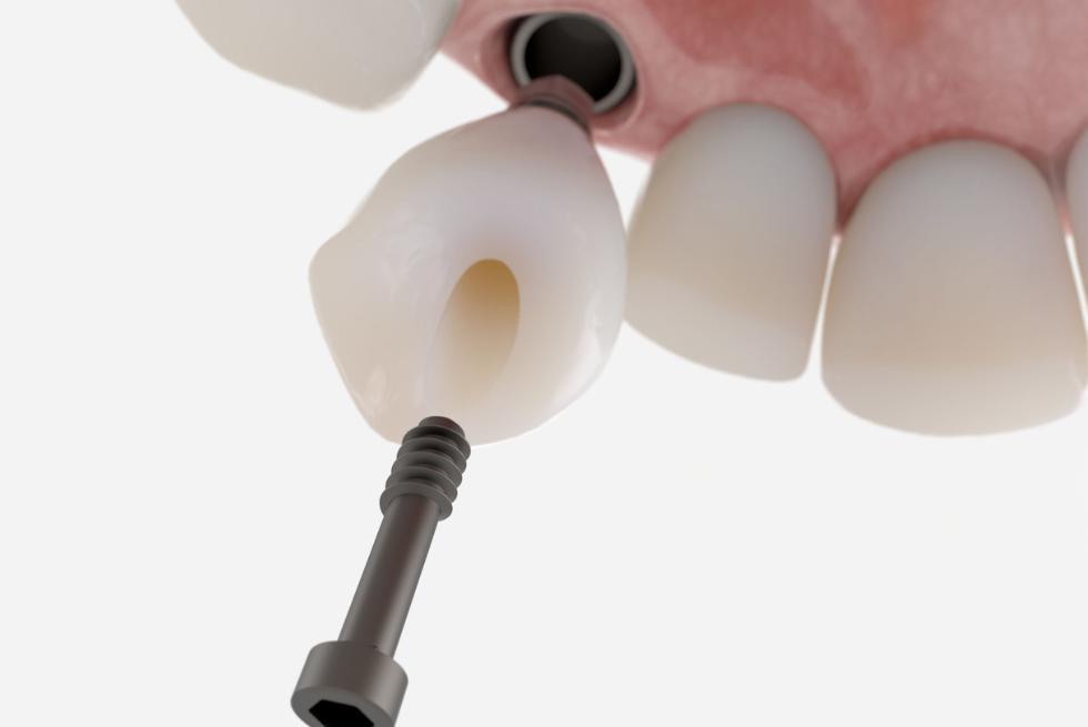 My Dental Implant Feels Loose! Is This an Emergency? How to Fix Loose Dental Implants