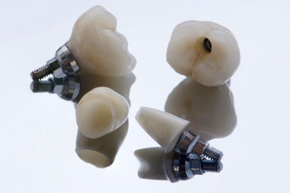 Top 7 Dental Implant Brands for Stellar Dental Care