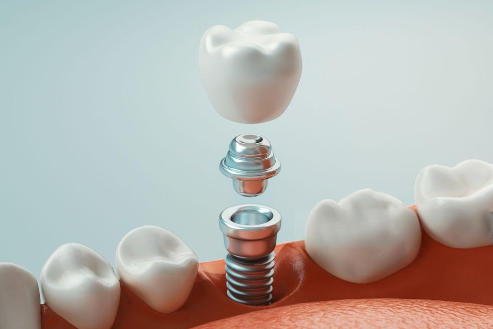 Dental Implants: Cost
