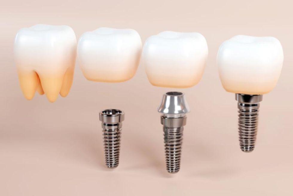 Types of Dental Implants