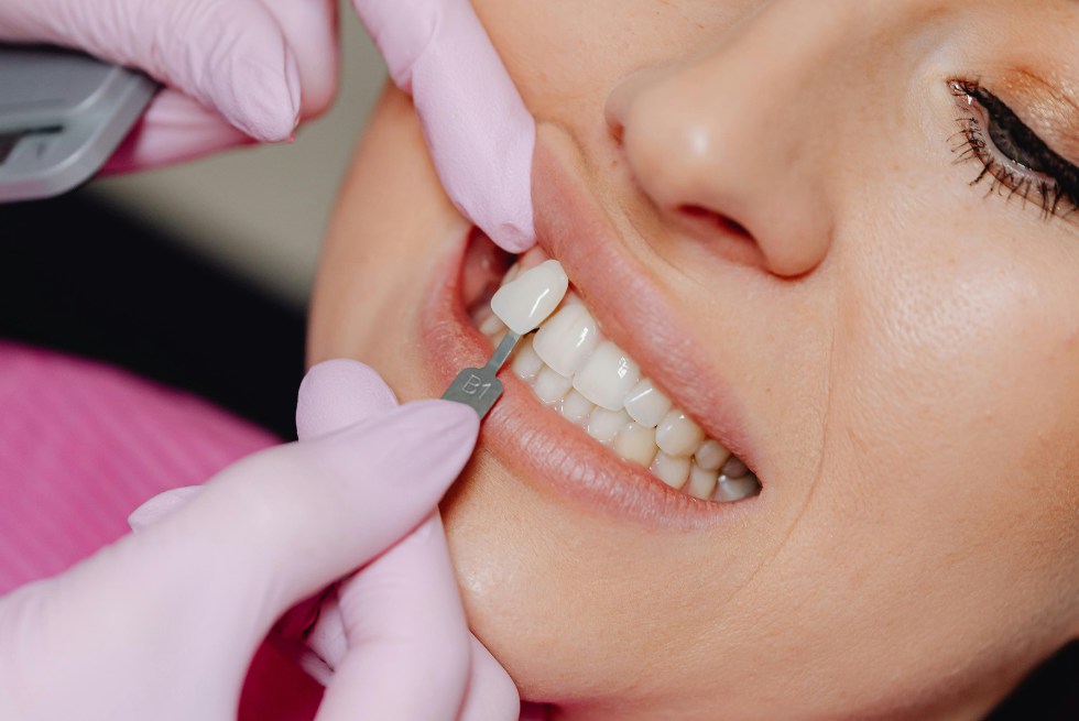 What Are Veneers? A Simple Guide
