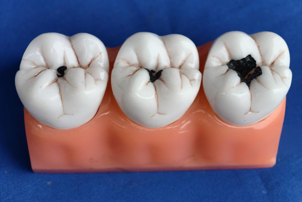 How to Get Rid of Cavities: Home & Professional Tips