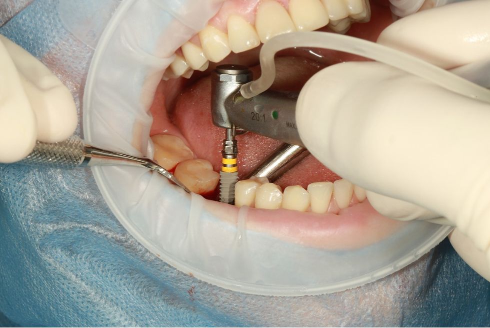 What Are Dental Implants? A Quick Overview