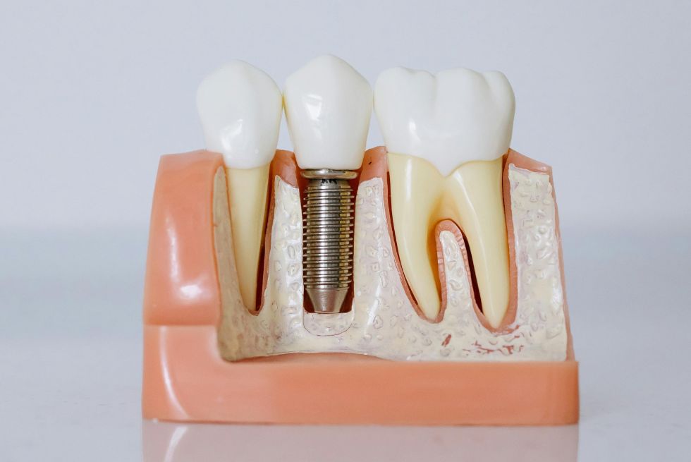 The Best Time for a Dental Implant: A Guide for Every New Patient After Tooth Loss
