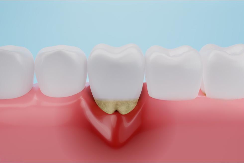 What Is Periodontal Disease?