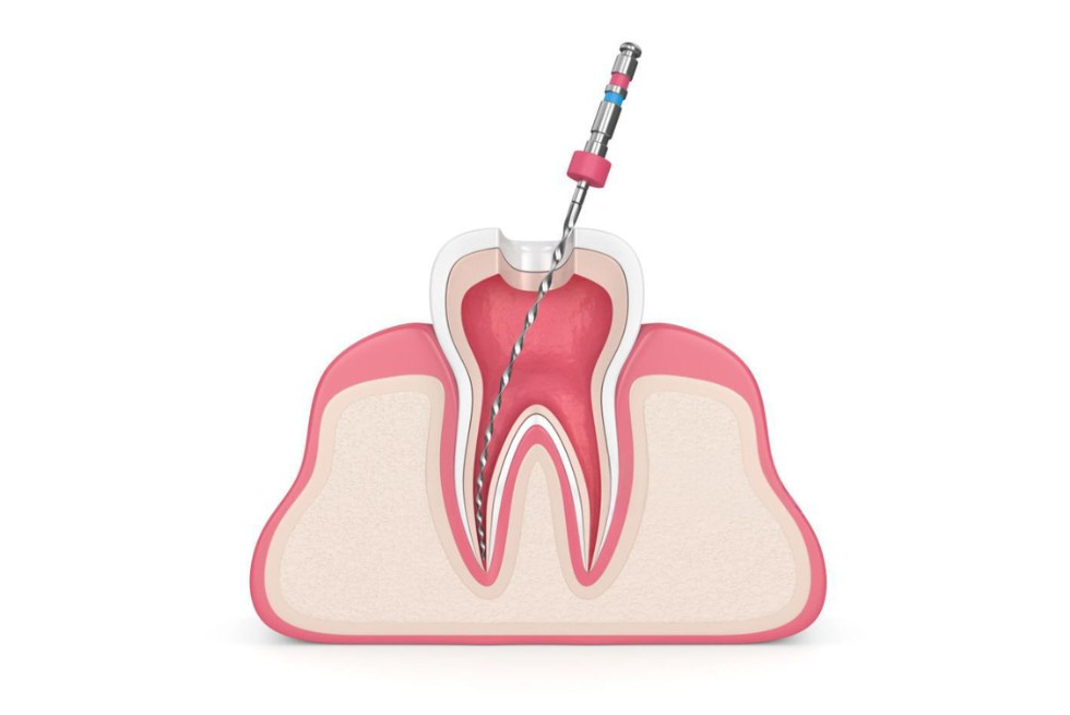 A Guide to the Dental Root Filling Procedure