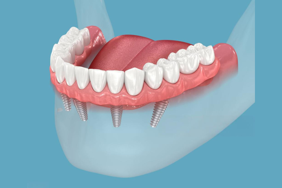 The Benefits of All-on-4 Dental Implants: My Guide to a New Smile