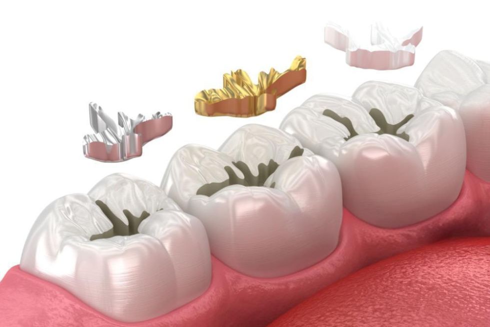 Best Dental Filling: Which Type Fits Your Tooth?