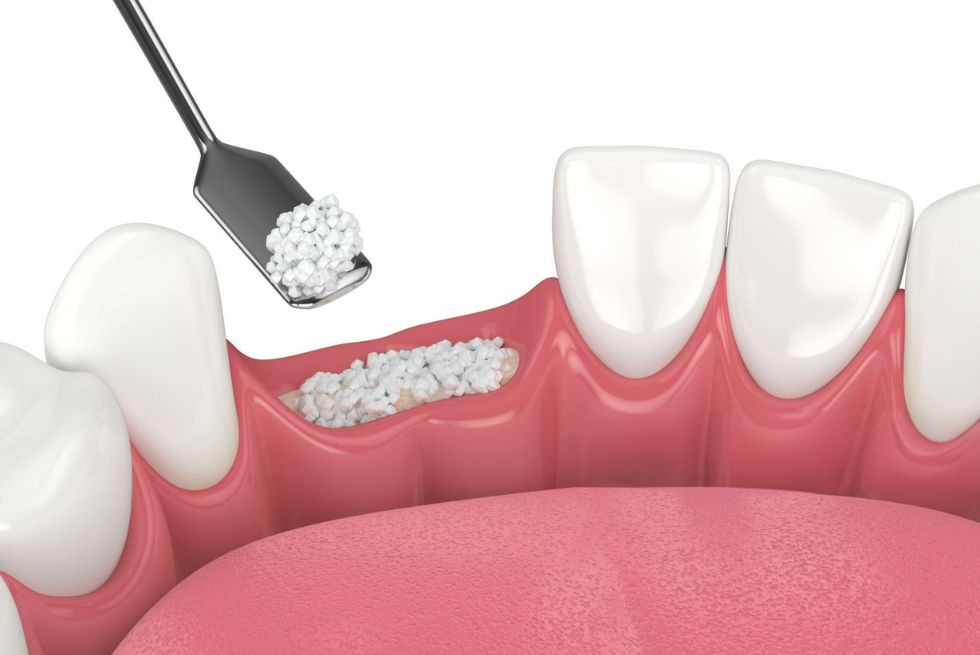 Best Bone Graft Material for Dental Implants?