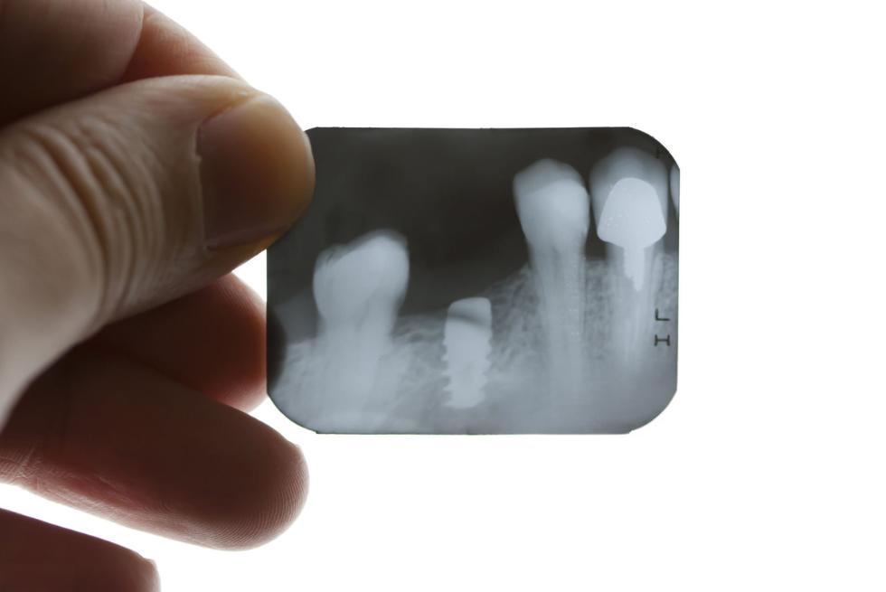 Can Your Dental Implant Become Infected and Cause Problems Years Later?