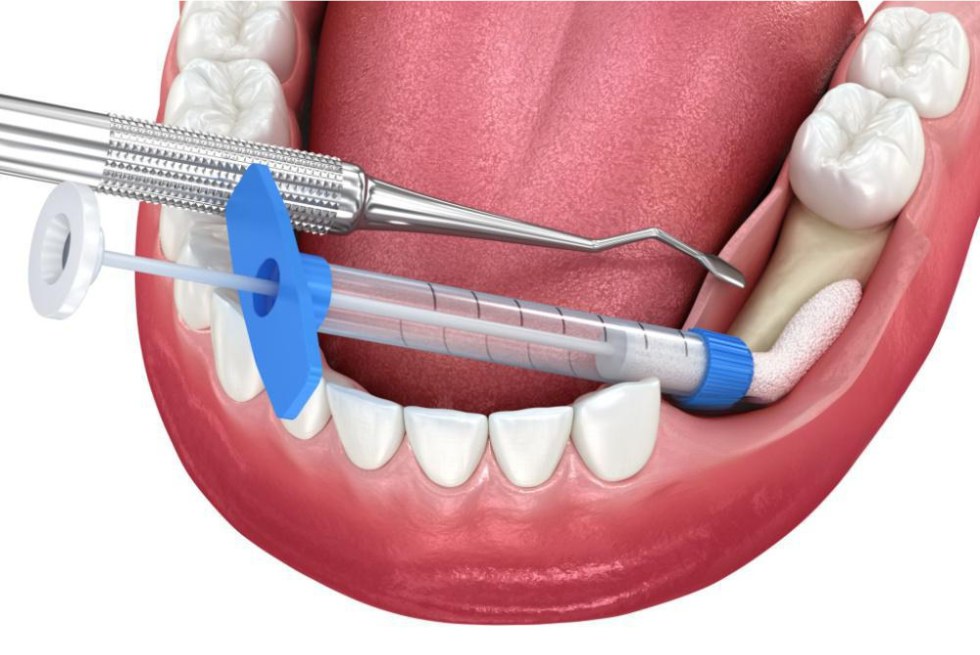 All You Need to Know About a Dental Bone Graft Before Your Dental Implant Surgery
