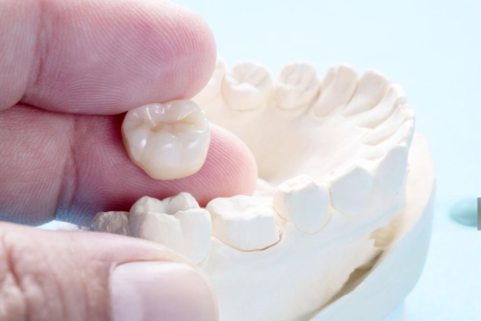 Dental Crowns: Types, Procedure & Cost