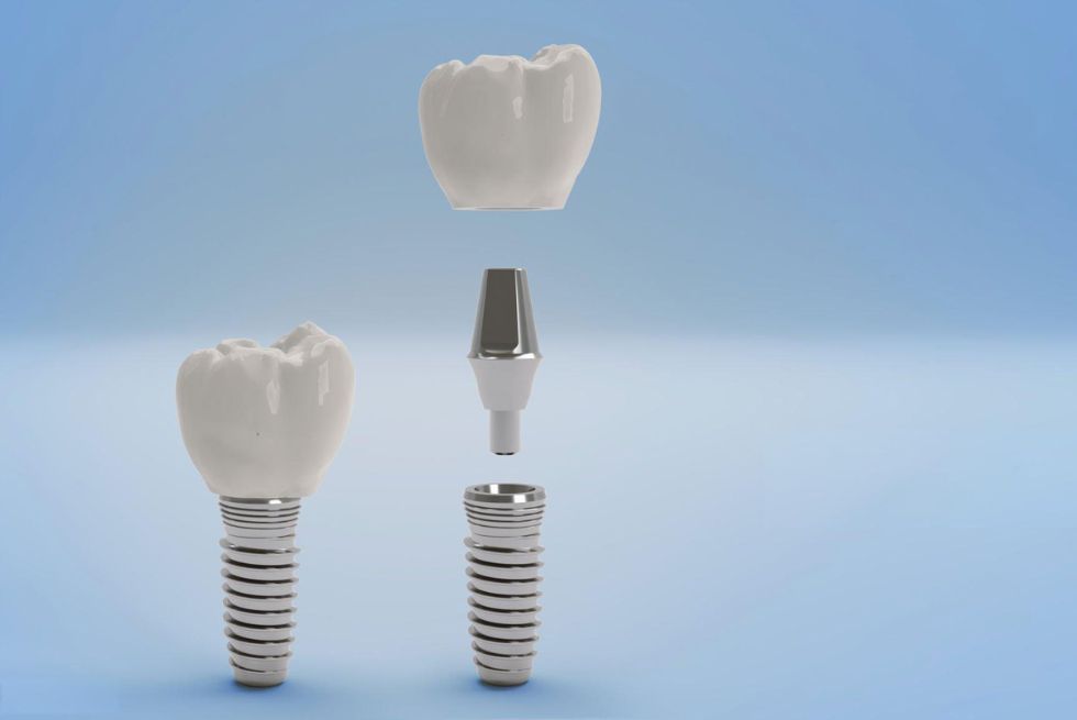 What to Do When Your Dental Implant Crown Feels Loose