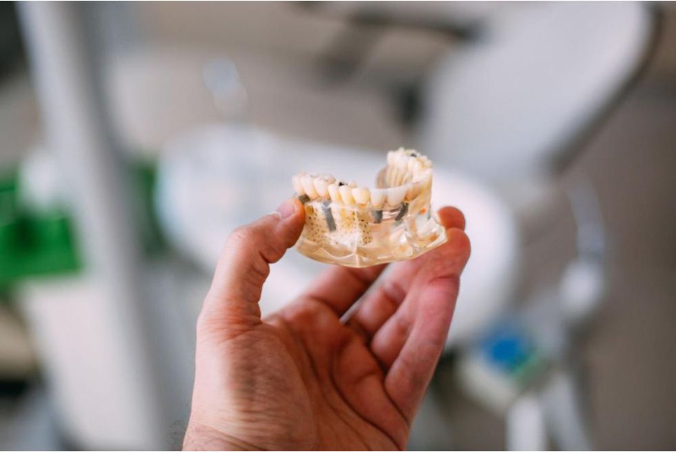 Dental Implant Parts - What You Need to Know