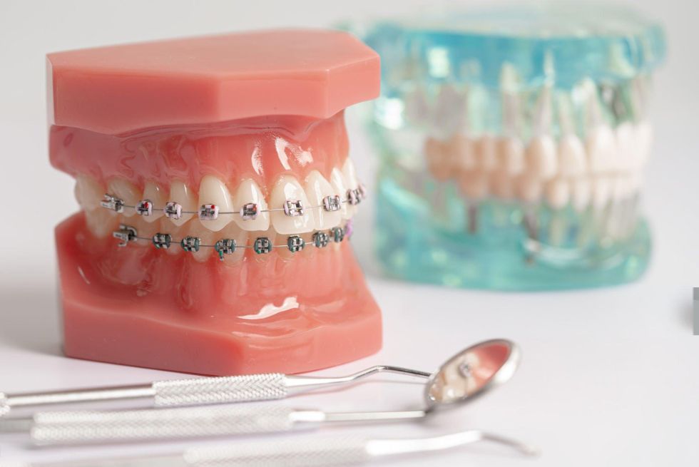 Denture Relines & Rebases: Essential Guide by ISTAR