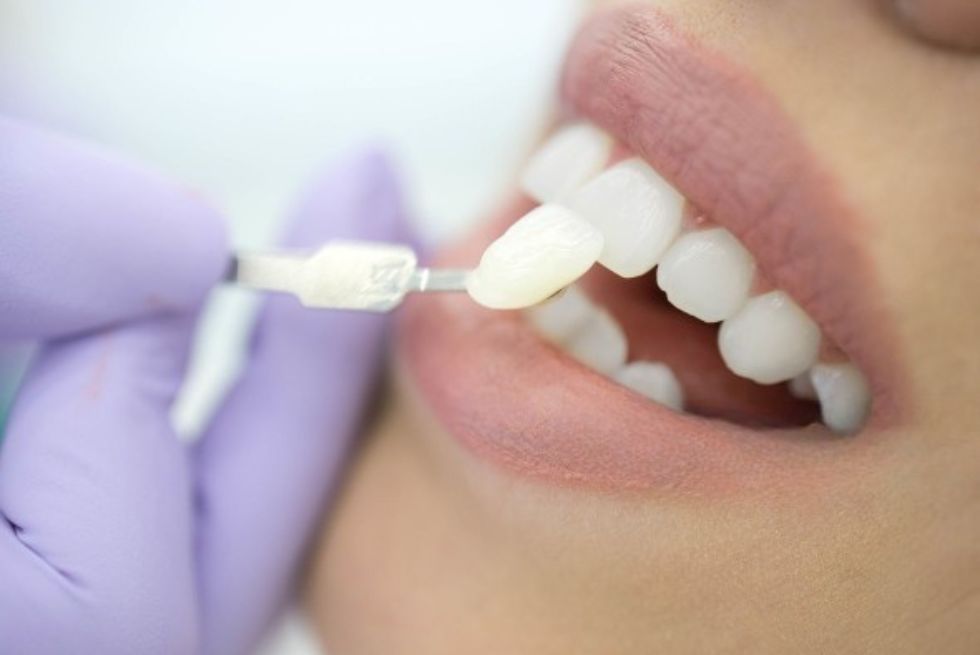 Emax vs. Zirconia Veneers: A Comprehensive Guide