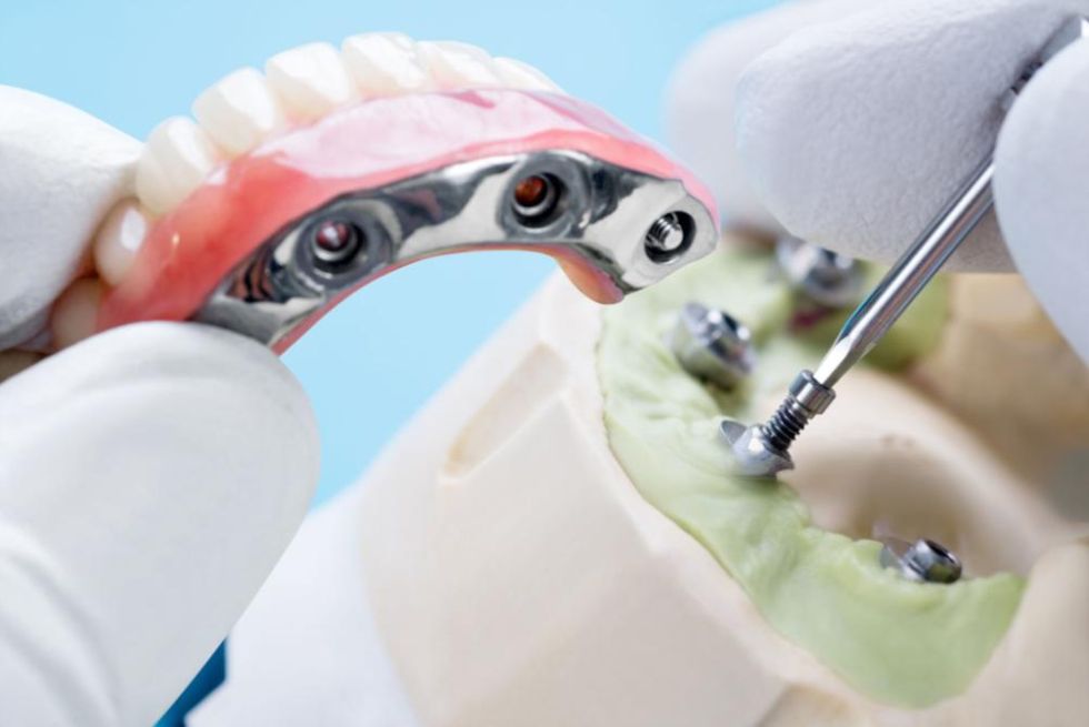 Implant Overdenture Steps and Clinical Protocol