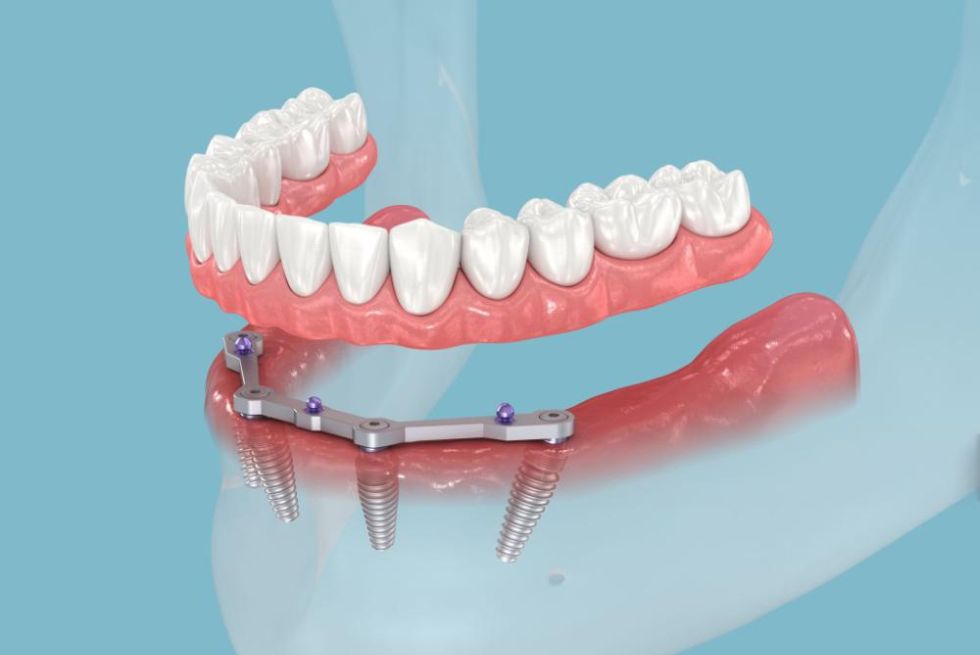 The Cheapest Countries for Dental Implants: My Guide to Getting Your Smile Back Without Breaking the Bank