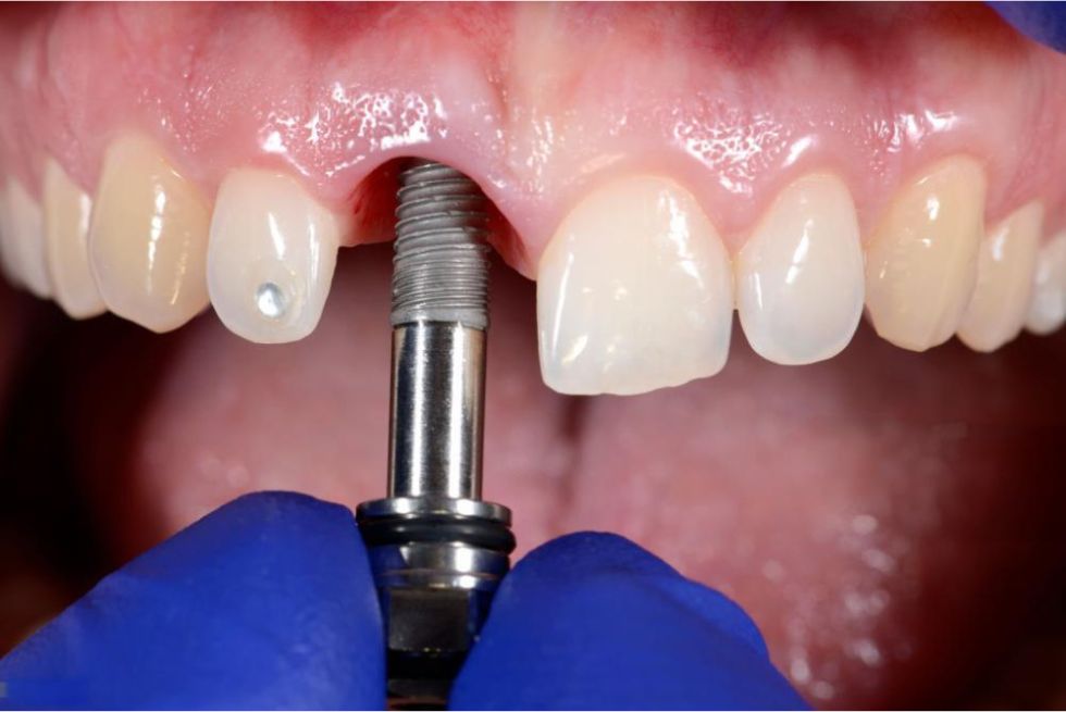 Can You Get a Dental Implant Years After a Tooth Extraction?
