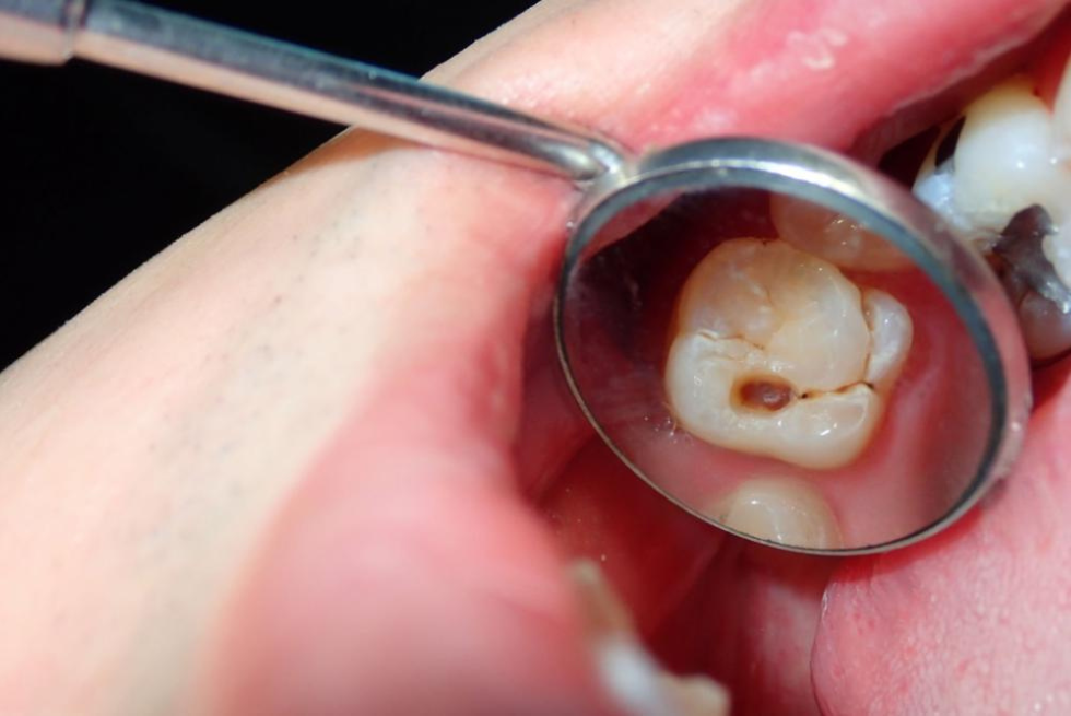 Cavity Pictures: What Does Tooth Decay Look Like?