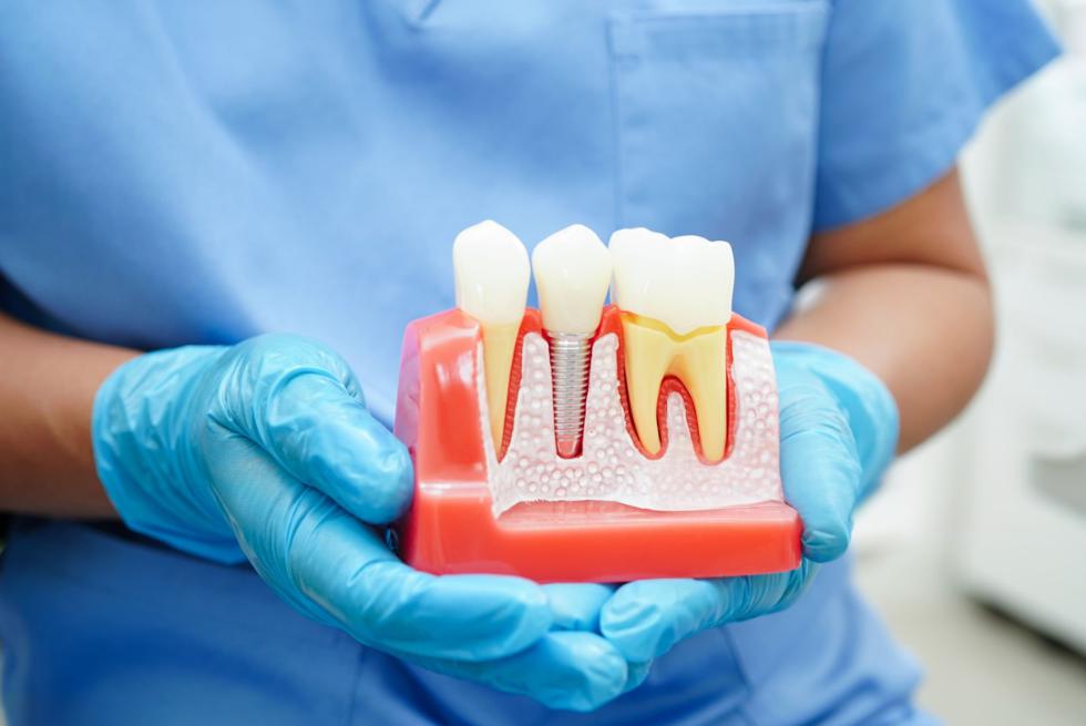 What Is Prosthodontics?