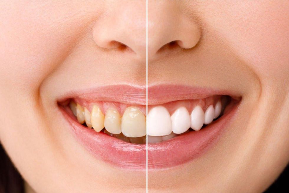 The Ultimate Guide to Teeth Whitening