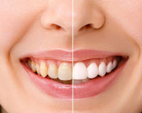 The Ultimate Guide to Teeth Whitening