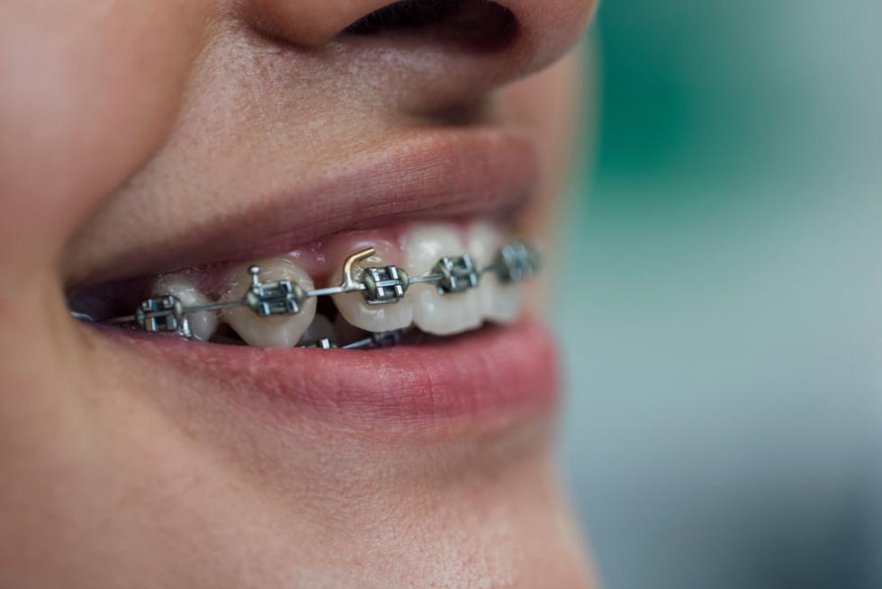 The Buccal Tube: The Secret Anchor in Your Dental Brace