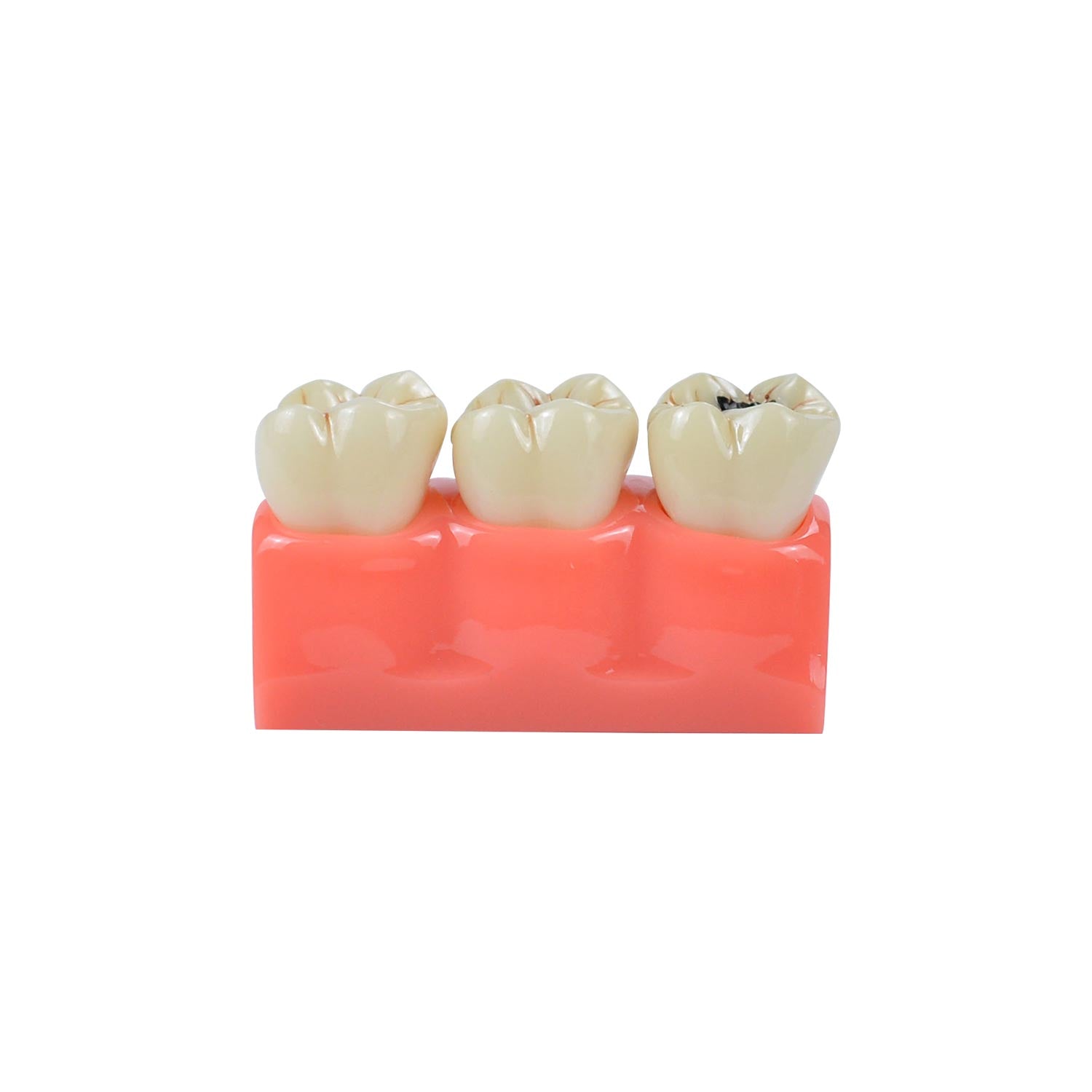 Caries Model Dental, 4x Caries Demonstration Model, Removable Teeth Models For Teaching