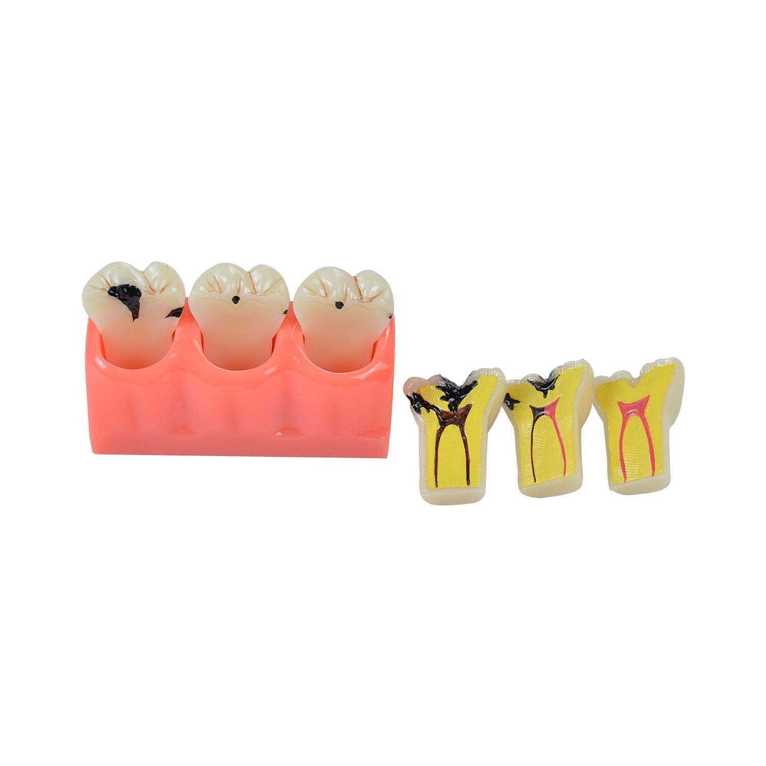 Caries Model Dental, 4x Caries Demonstration Model, Removable Teeth Models For Teaching