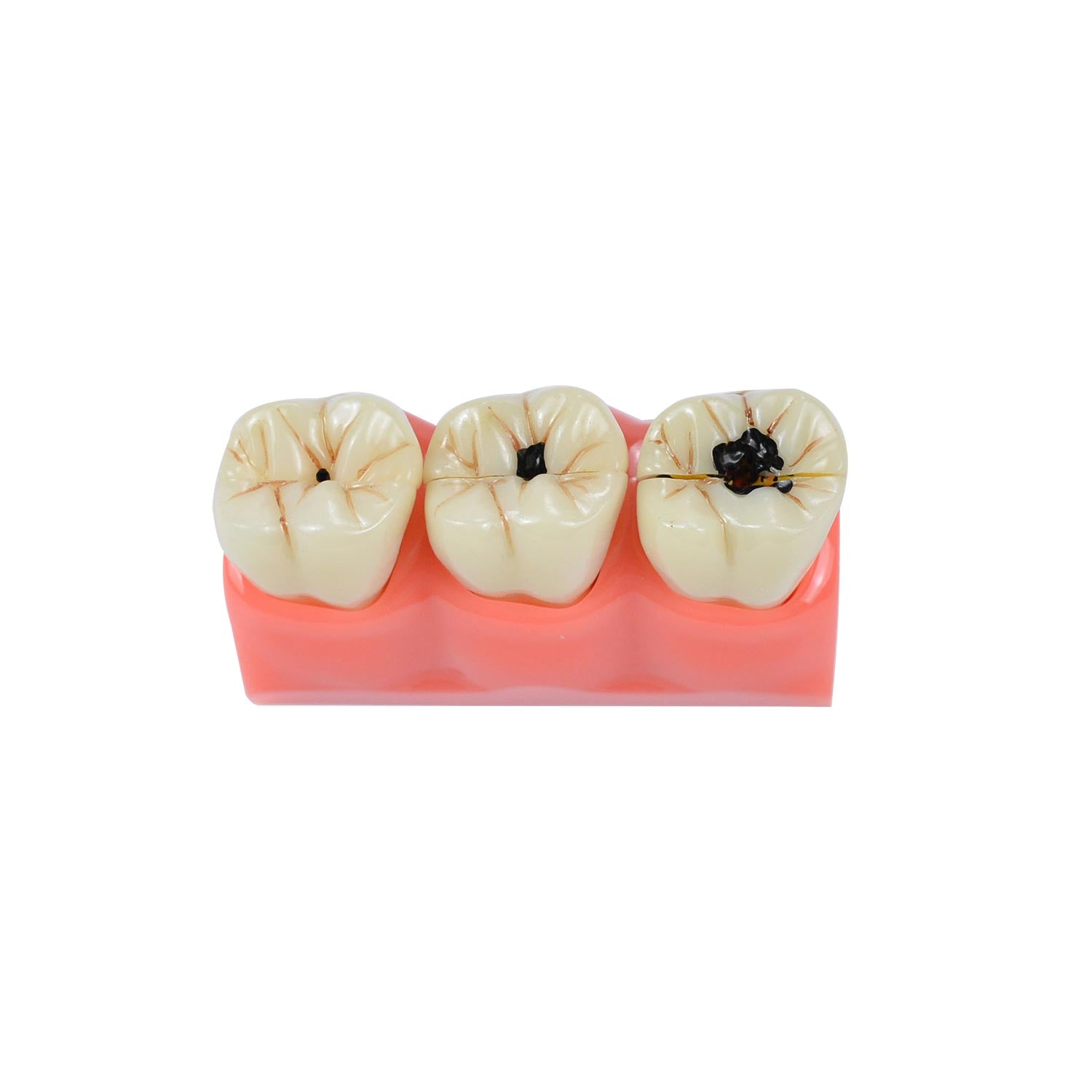 Caries Model Dental, 4x Caries Demonstration Model, Removable Teeth Models For Teaching