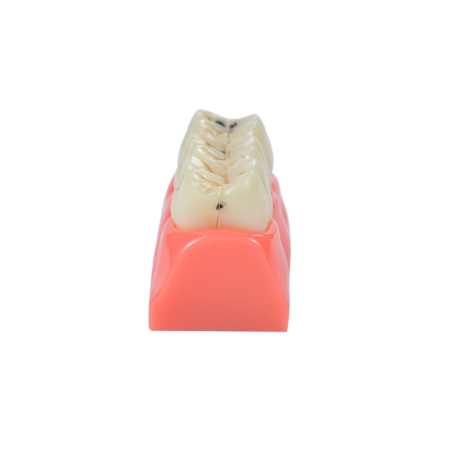 Caries Model Dental, 4x Caries Demonstration Model, Removable Teeth Models For Teaching