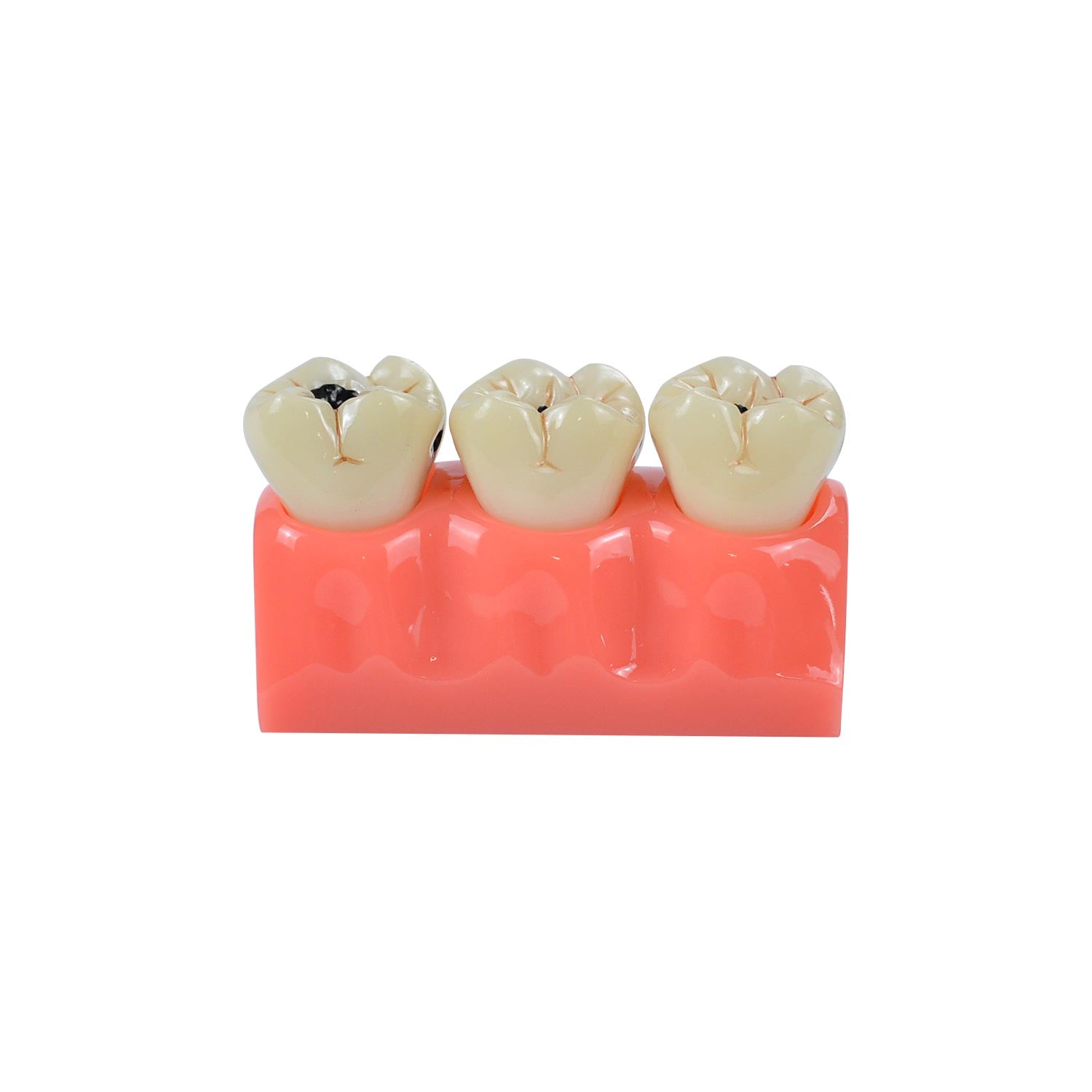 Caries Model Dental, 4x Caries Demonstration Model, Removable Teeth Models For Teaching