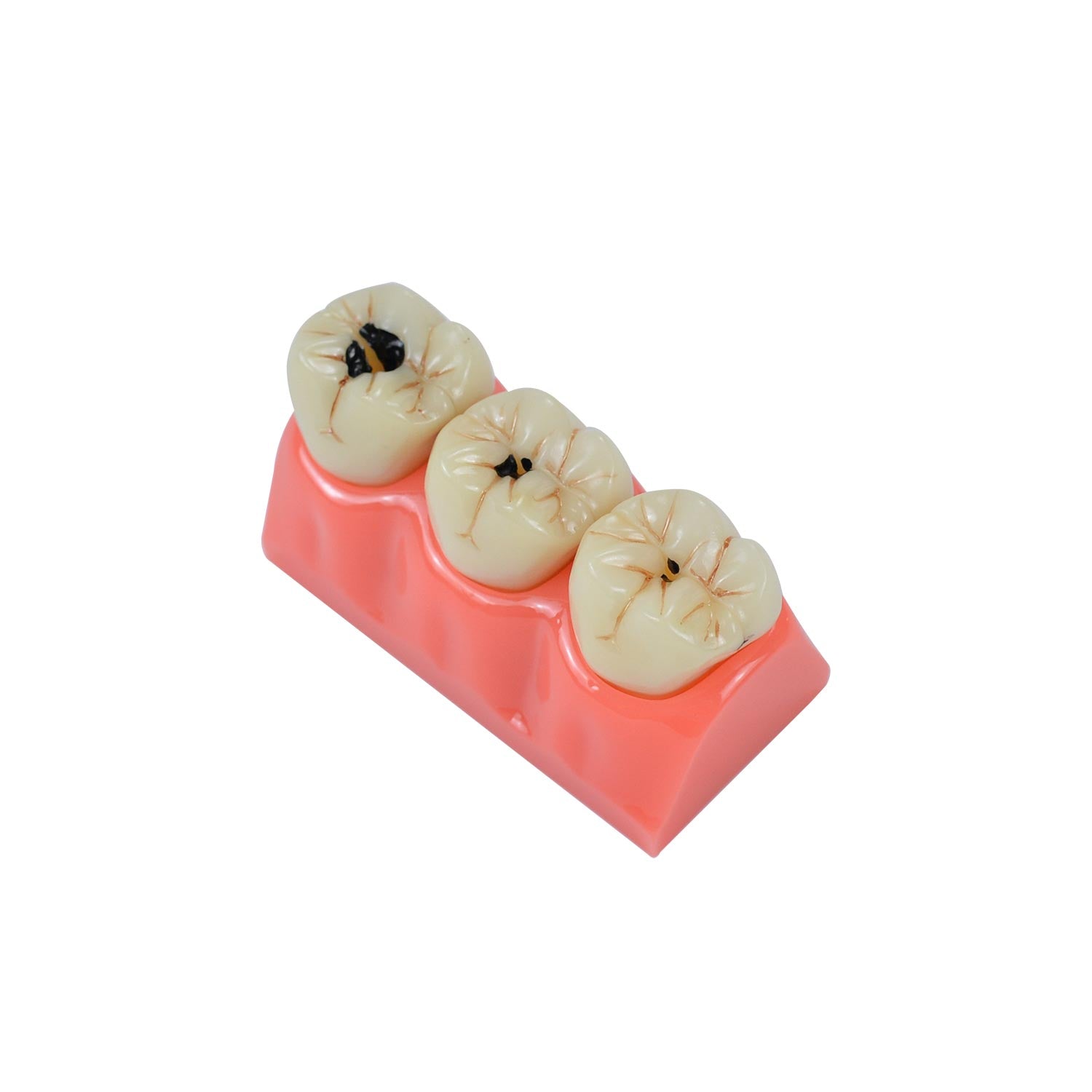 Caries Model Dental, 4x Caries Demonstration Model, Removable Teeth Models For Teaching