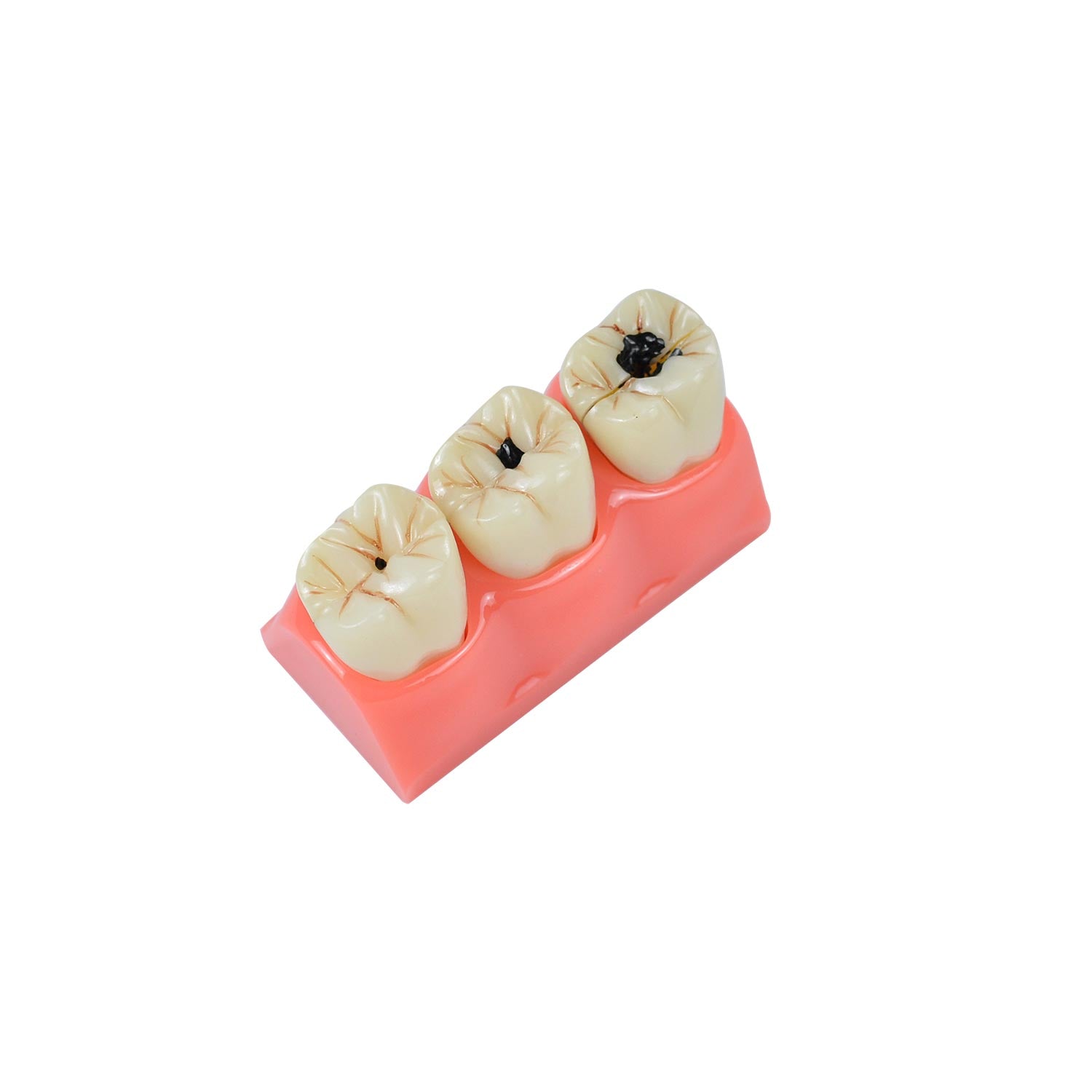 Caries Model Dental, 4x Caries Demonstration Model, Removable Teeth Models For Teaching