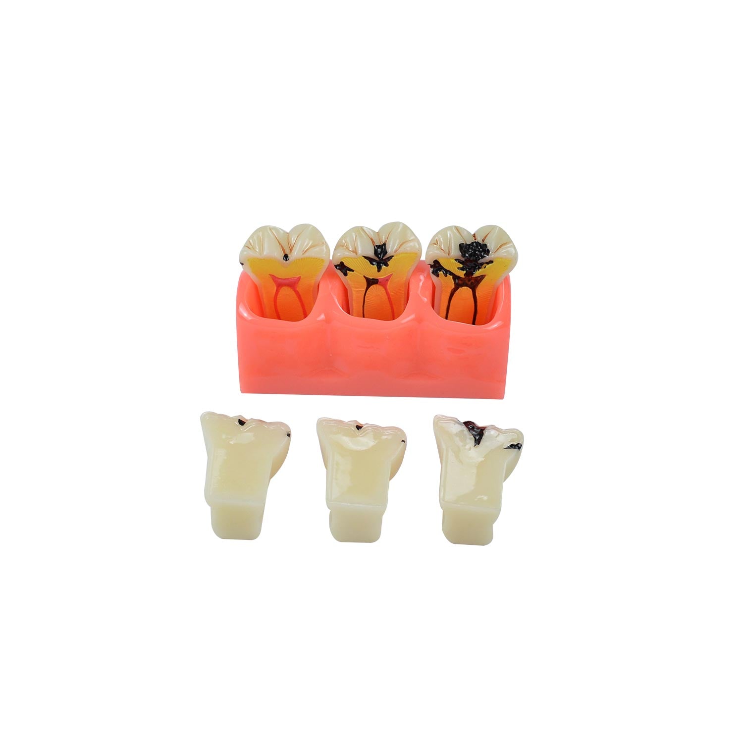 Caries Model Dental, 4x Caries Demonstration Model, Removable Teeth Models For Teaching