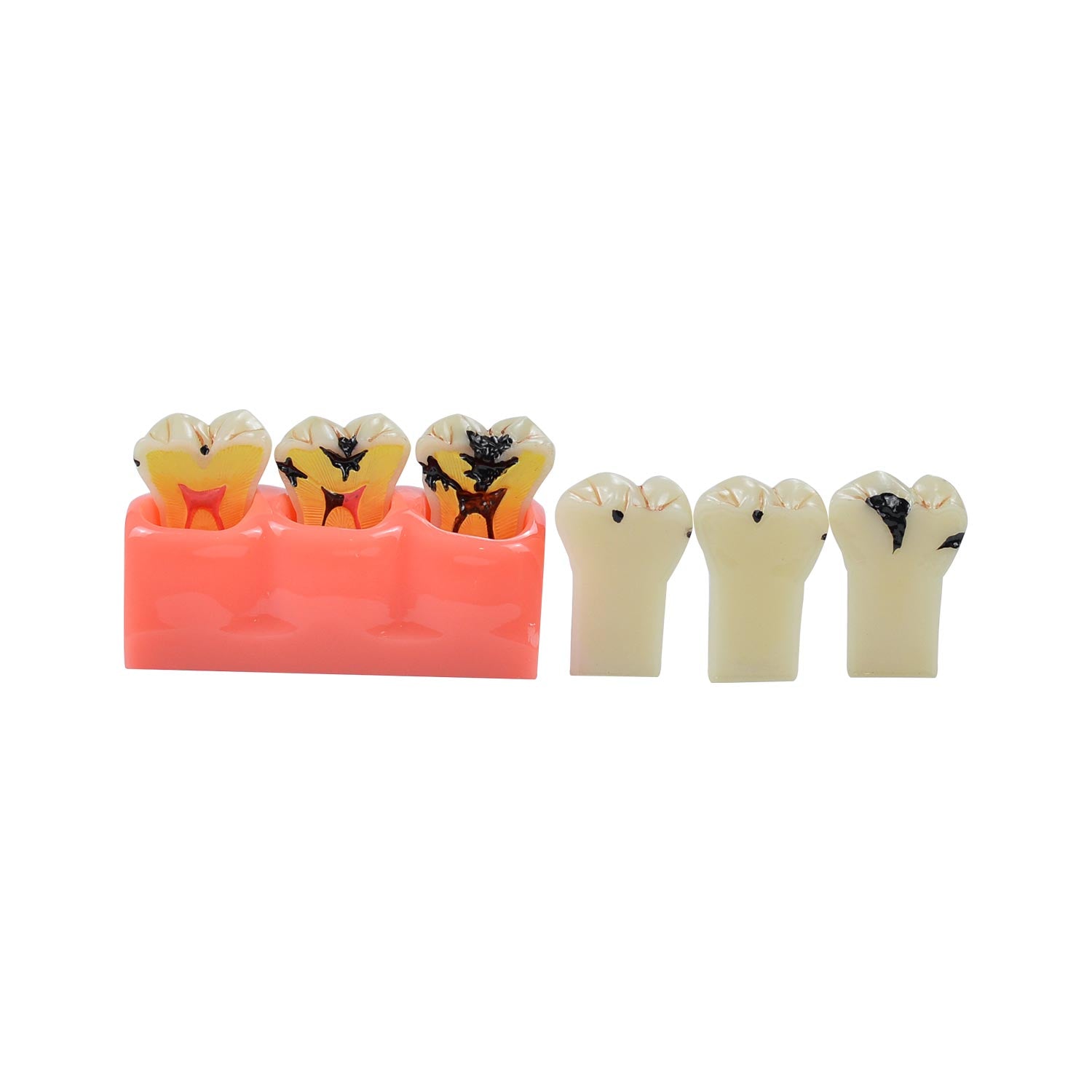 Caries Model Dental, 4x Caries Demonstration Model, Removable Teeth Models For Teaching