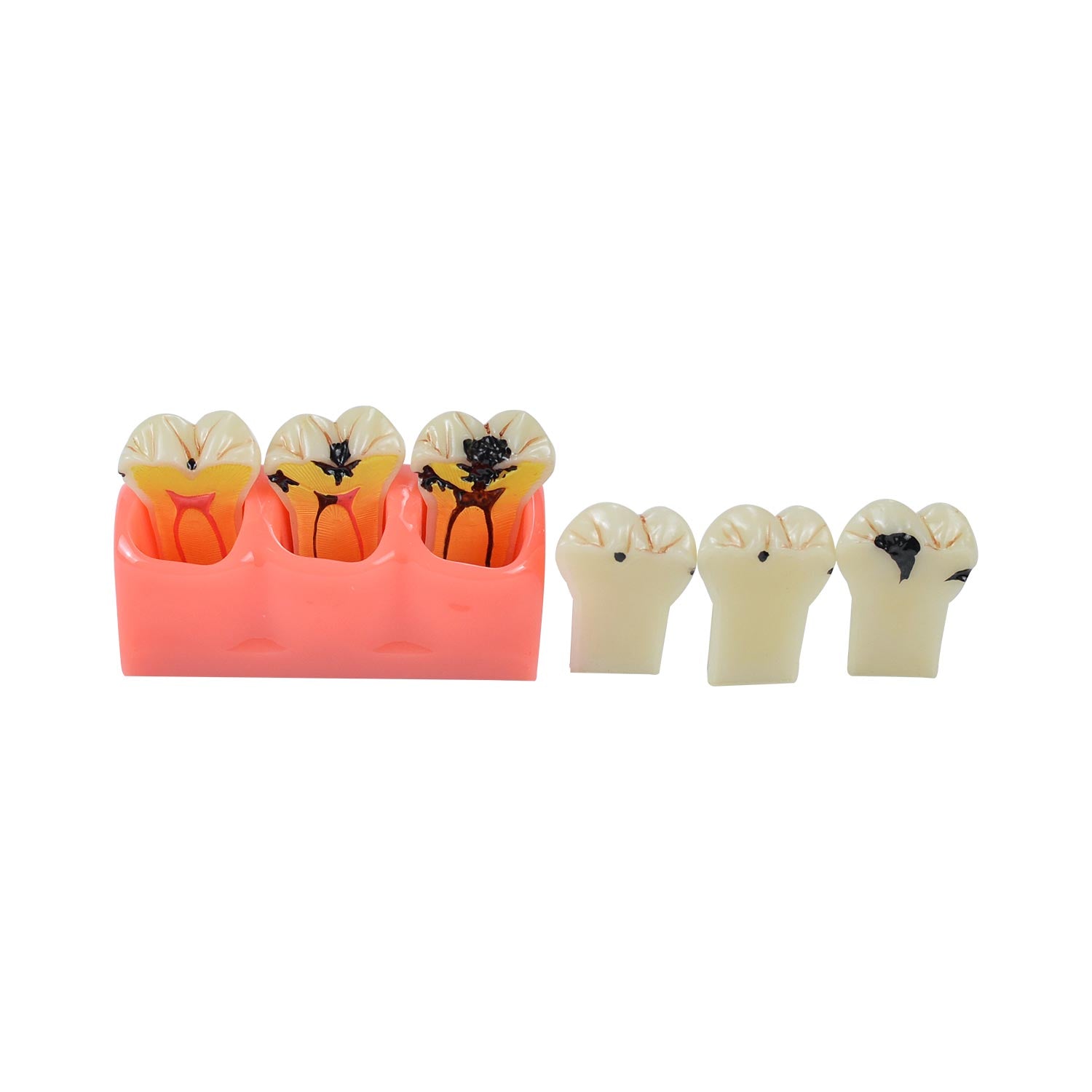 Caries Model Dental, 4x Caries Demonstration Model, Removable Teeth Models For Teaching