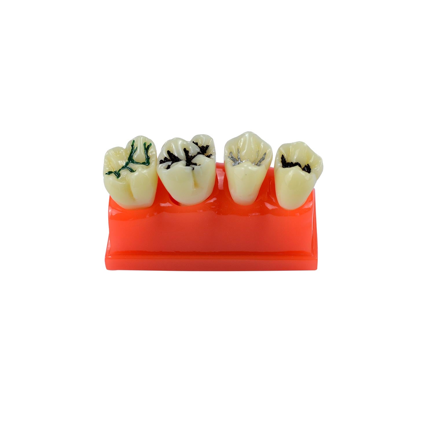 Dental Caries Teeth Model, 4 Teeth Dental Study Models