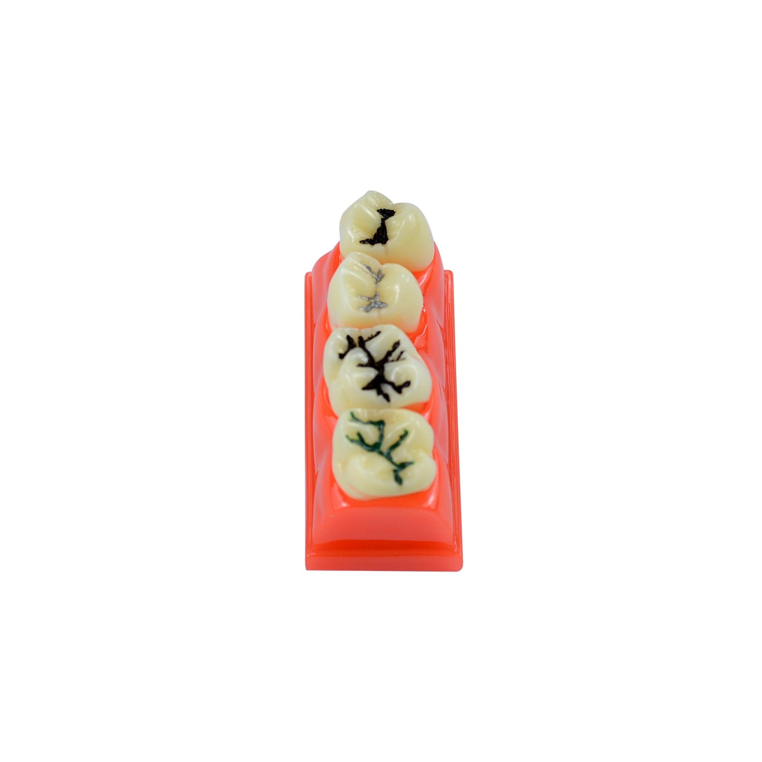 Dental Caries Teeth Model, 4 Teeth Dental Study Models