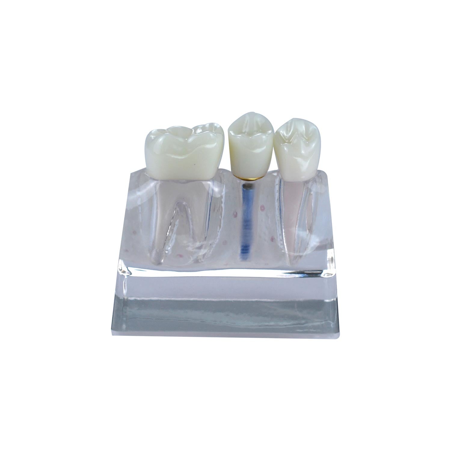 Dental Implant Demonstration Model, Transparent 4x Triple Crown Implant Display Model