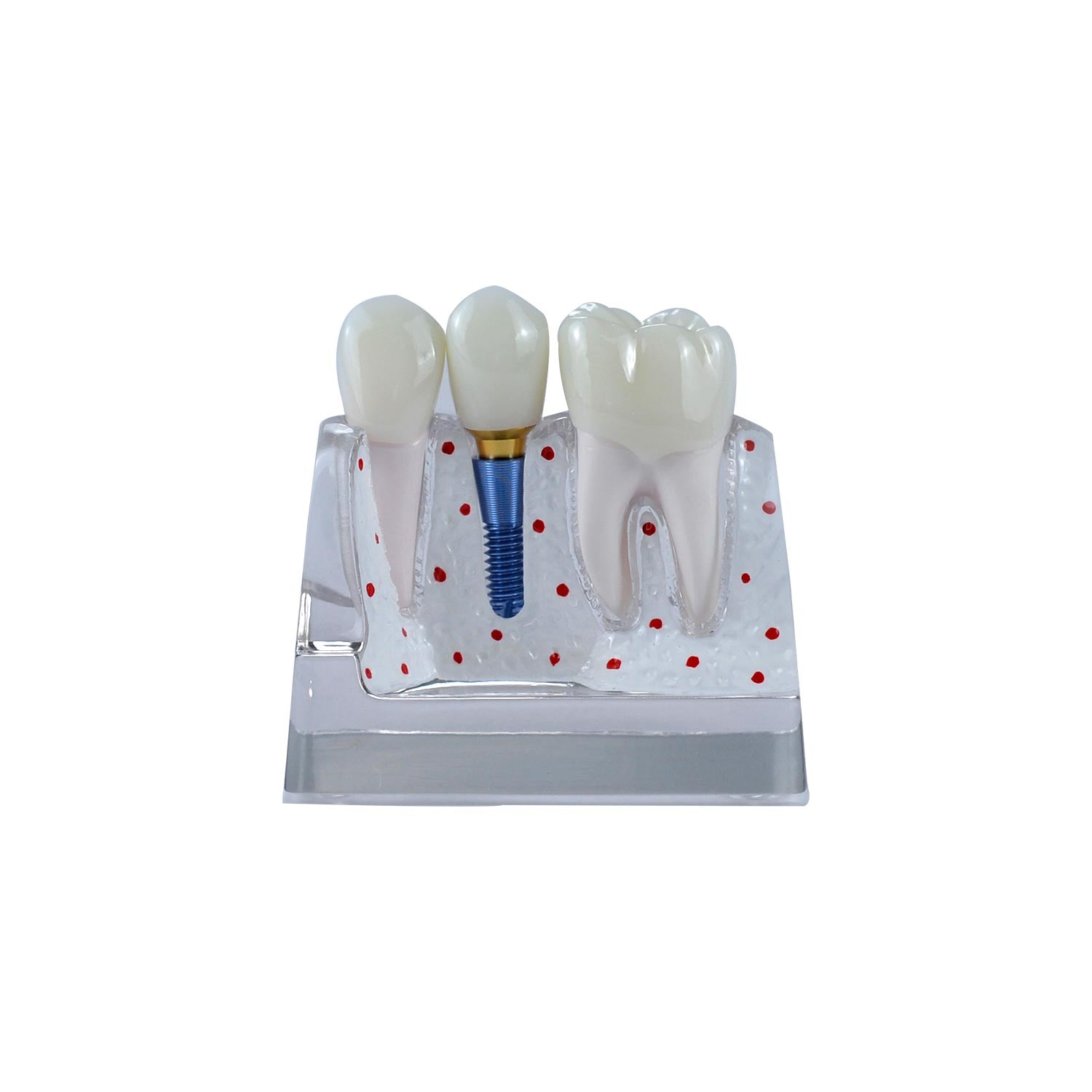 Dental Implant Demonstration Model, Transparent 4x Triple Crown Implant Display Model