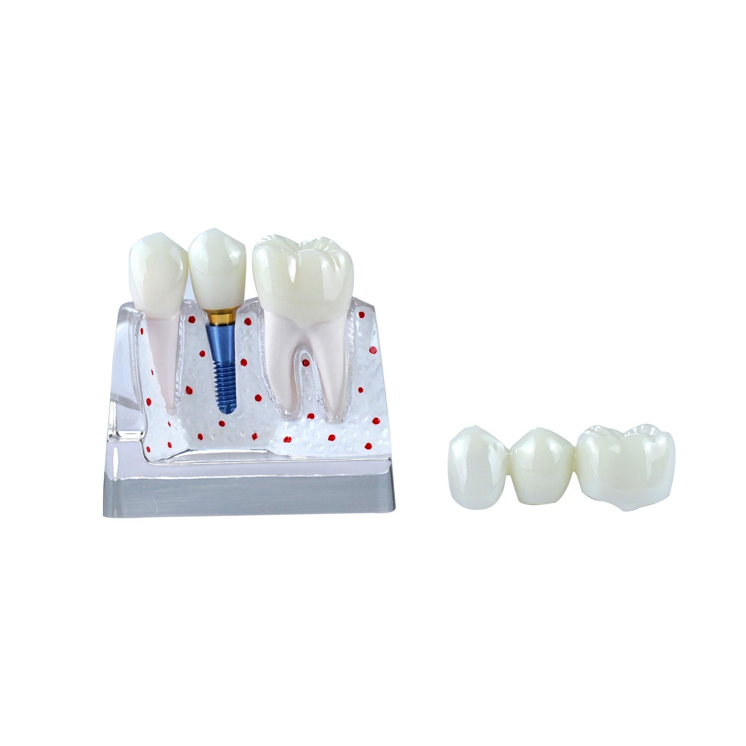 Dental Implant Demonstration Model, Transparent 4x Triple Crown Implant Display Model