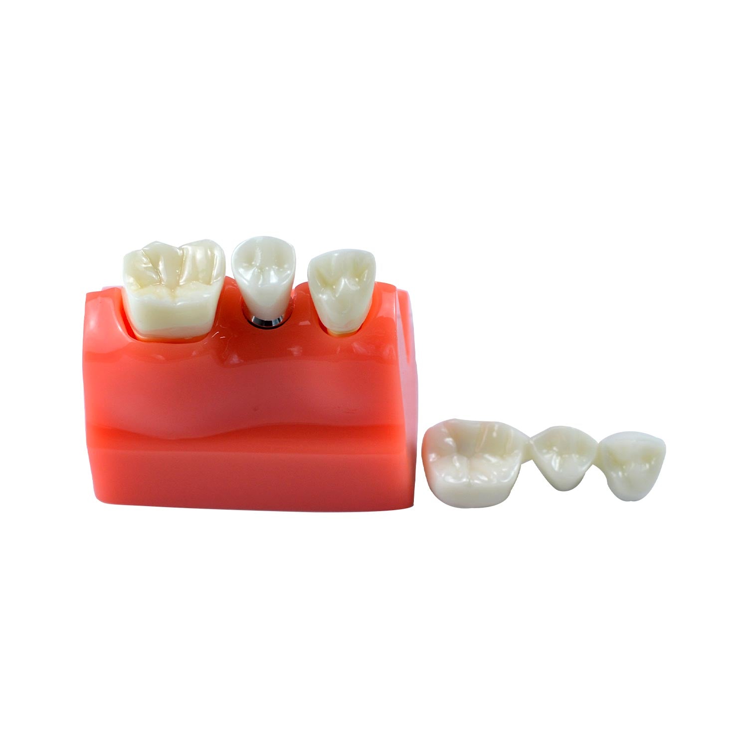 Dental Implant Model, 4x Triple Crown Implant Display Model