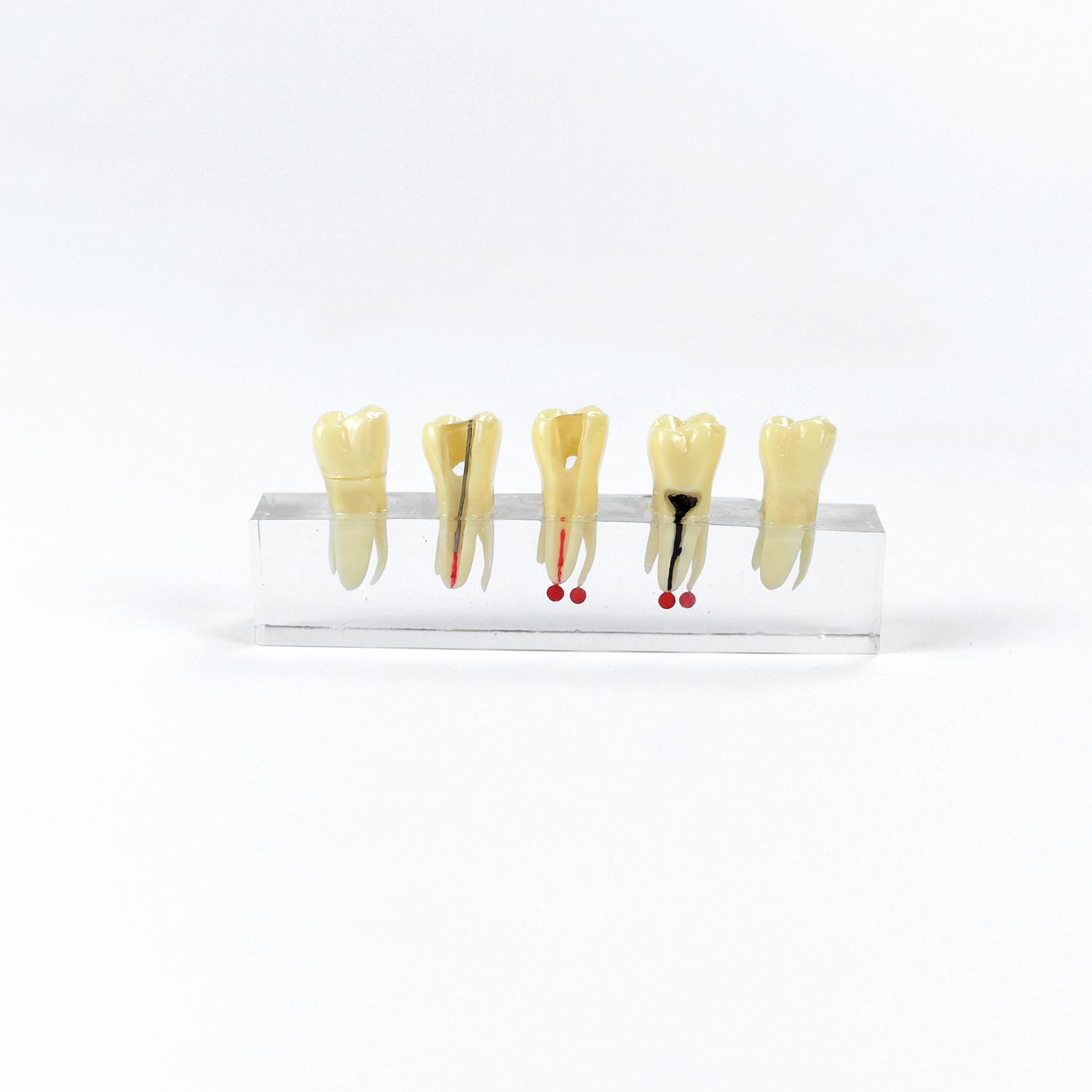 Dental Root Canal Model, Teeth Endodontic Dental Pathology Model For Patient Education